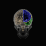Alzheimer #103