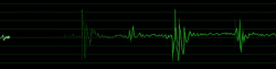 Ekg #2