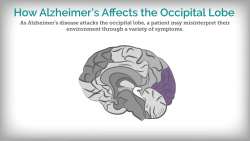 Alzheimers #8