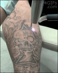 Forgifs.com, Laser tattoo removal